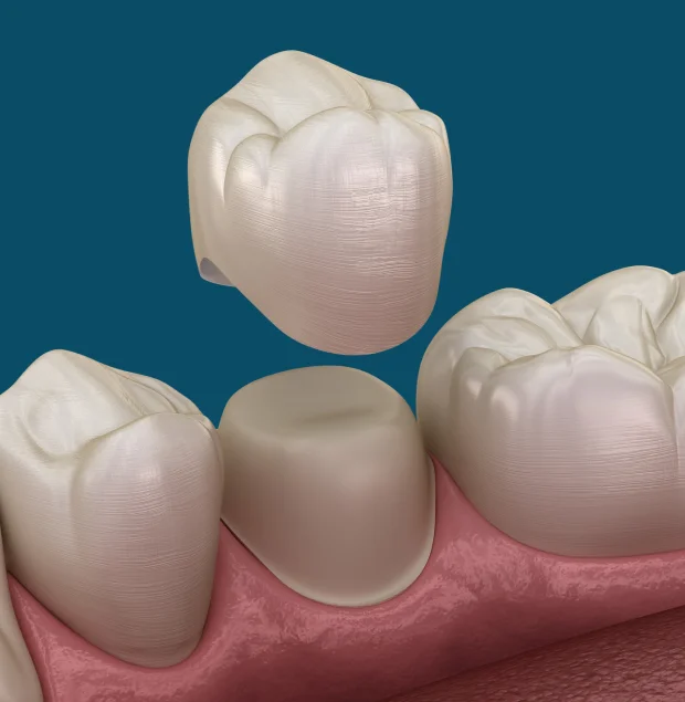 Dental crowns replacing damaged teeth