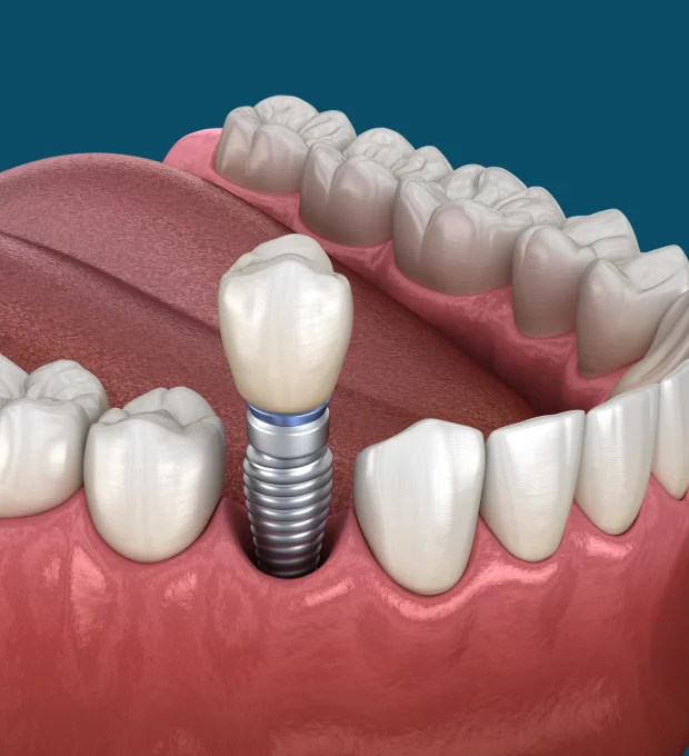 Dental implant restoration illustration