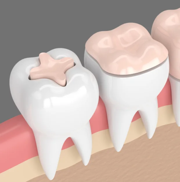 Dental inlays and onlays illustration