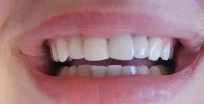 Close-up of teeth after dental treatment with a straighter, brighter smile.