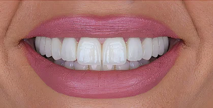 Close-up of teeth after dental treatment with bright, evenly shaped teeth and a natural smile