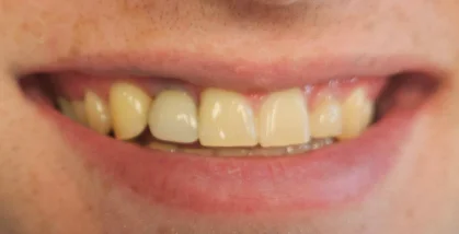 Close-up of teeth after dental treatment with a brighter, more even smile.