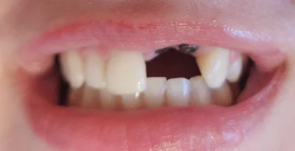 Close-up of teeth before dental treatment with uneven spacing and discoloration.