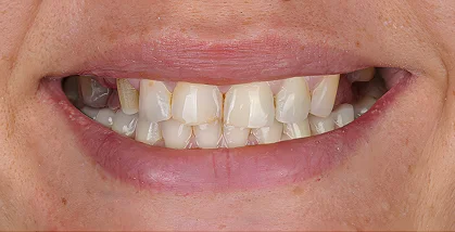 Close-up of teeth before dental treatment with an uneven smile and visible discoloration.
