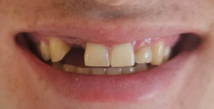 Close-up of teeth before dental treatment with yellowing and uneven teeth.