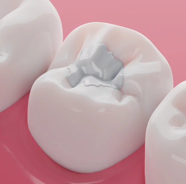 Tooth-colored dental filling illustration